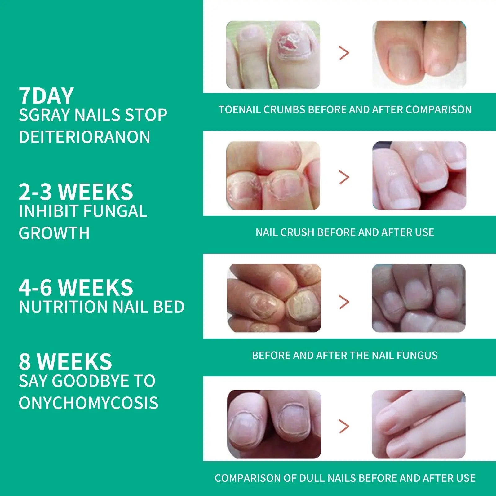 Nail Fungus Solution, Anti Infection Nail Fungus Removal Gel, Ingrown Toenail Treatment Nail Care Oil, Nail Fungus Treatments Serum Nail Fungus Solution, Anti Infection Nail Fungus Removal Gel, Ingrown Toenail Treatment Nail Care Oil, Nail Fungus Treatments Serum